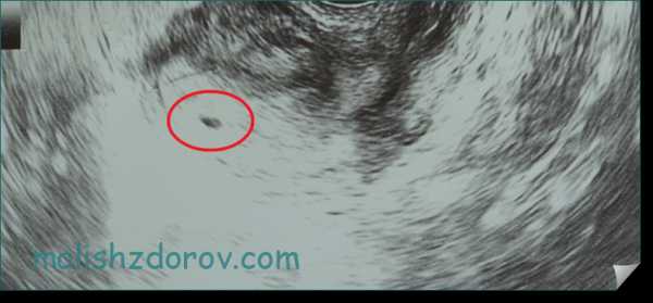 Первые признаки беременности на 1-2 неделе после зачатия