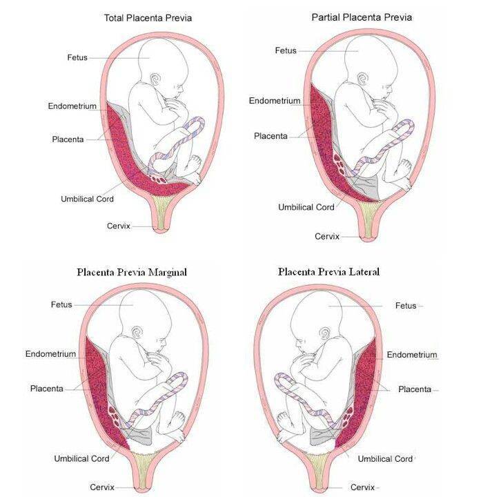 Что означает предлежание плаценты по передней стенке матки и на что оно влияет?