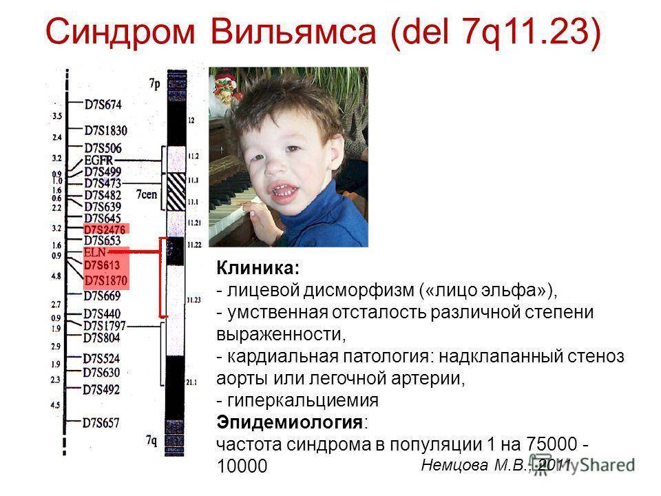 Синдром вильямса презентация