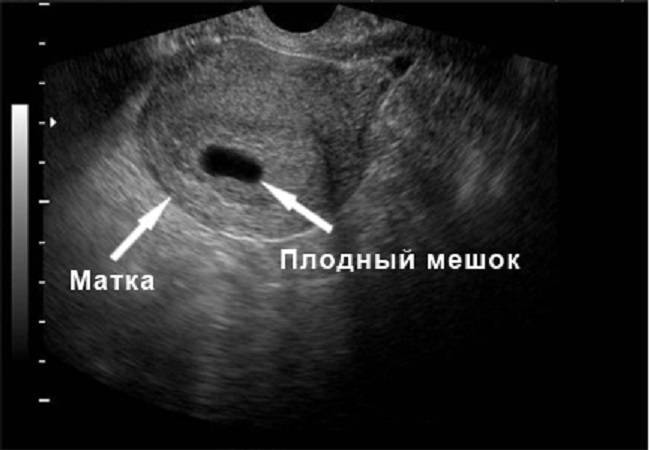 5 неделя беременности эмбрион не визуализируется - беременная