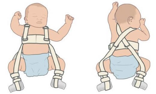 Дисплазия тазобедренных суставов у новорожденных