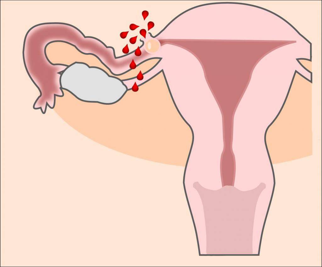 Чем опасны спайки в матке и возможна ли беременность при синдроме ашермана?