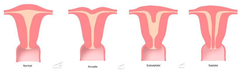 Понятие седловидной матки: что это значит и какие бывают формы, как выбрать позу для зачатия и можно ли забеременеть?