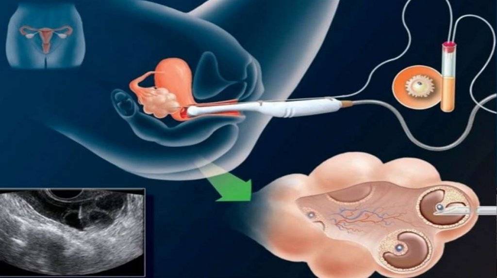 Подсадка эмбрионов при эко (27 фото): как происходит перенос, ощущения по дням, сколько эмбрионов подсаживают, тянет живот как перед месячными и низкий прогестерон