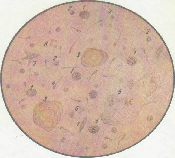 Лецитиновые зерна в секрете простаты: что это значит, проведение анализа, расшифровка спермограммы