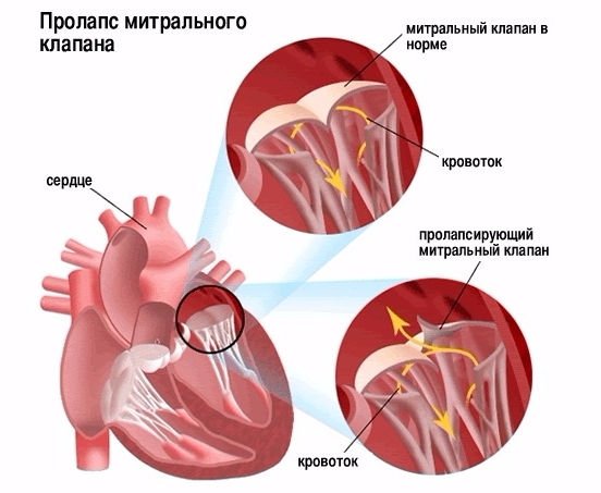Пролапс митрального клапана без нарушения гемодинамики | лечим сердце