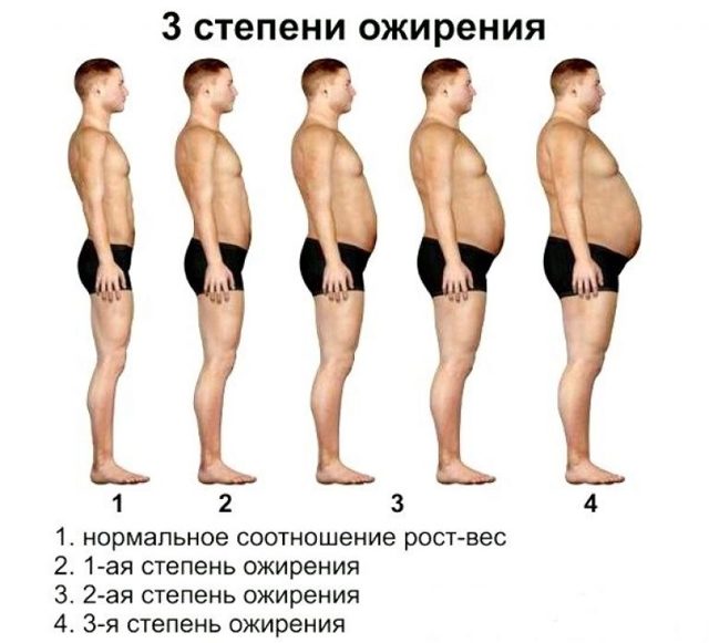 Ожирение 1, 2, 3 и 4-ой степени у детей: классификация, симптоматика, фото