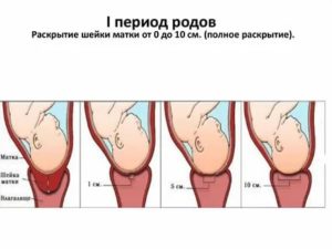 Процесс и этапы раскрытия шейки матки перед родами