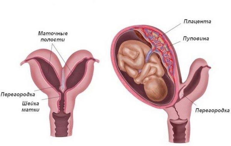 Седловидная матка : что это значит, влияние на беременность, узи признаки, роды | компетентно о здоровье на ilive