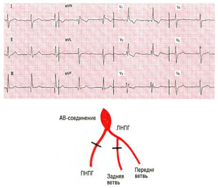 Неполная блокада правой ножки пучка гиса картинки