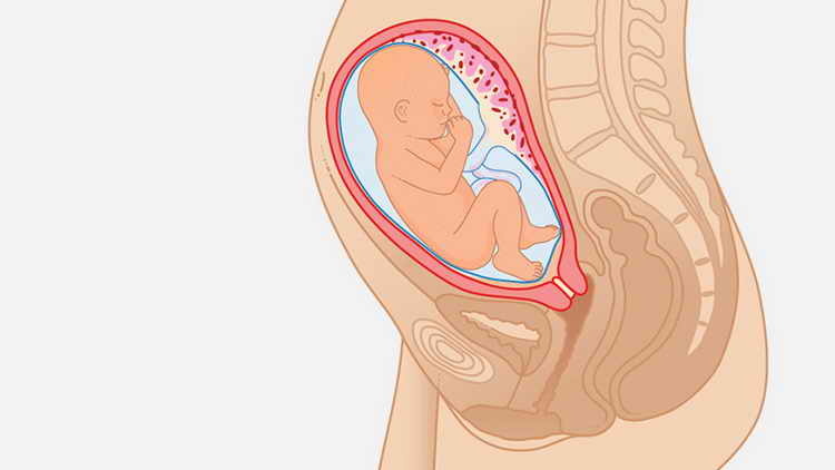 Роды на 34 неделе, особенности и возможные последствия