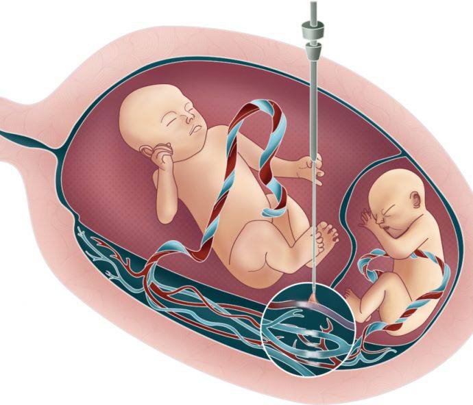 Признаки многоплодной беременности на ранних сроках: причины возникновения и особенности ведения