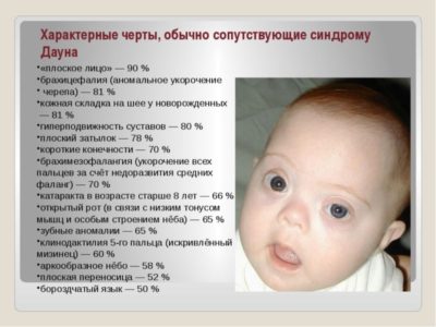 Признаки синдрома дауна у новорожденных