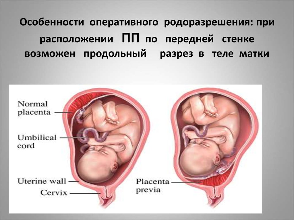 Низкая плацентация при беременности: что это такое, чем опасна, роды, что делать если плацента низко расположена / mama66.ru