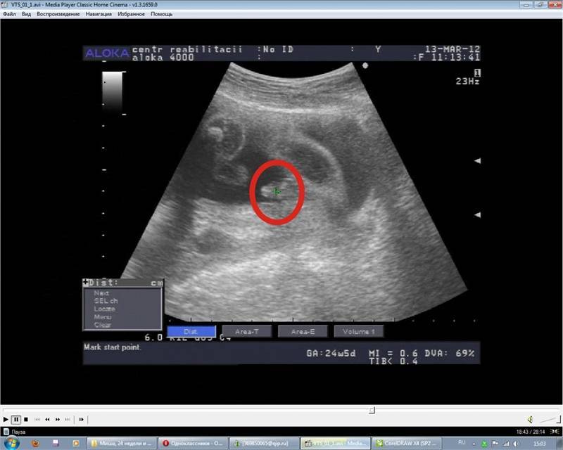 Можно ли спутать кисту яичника с беременностью на узи на раннем сроке