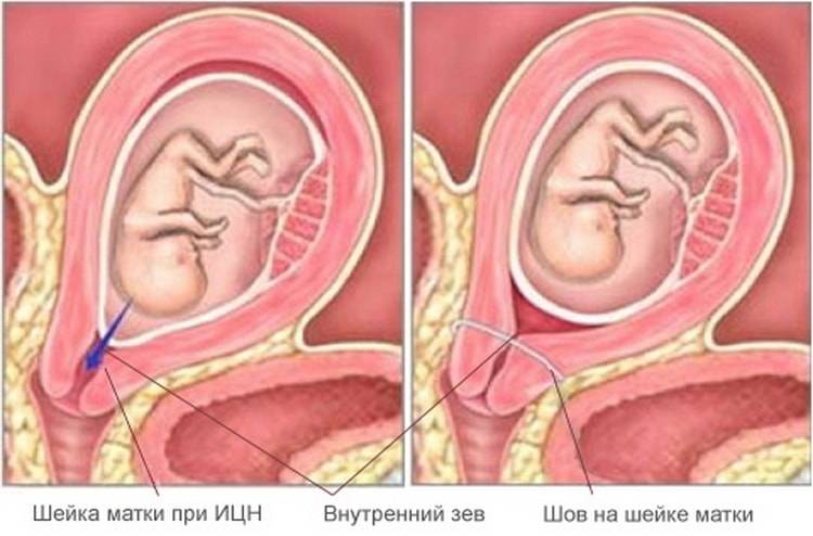 Утрожестан при беременности — инструкция по применению, противопоказания и отзывы
