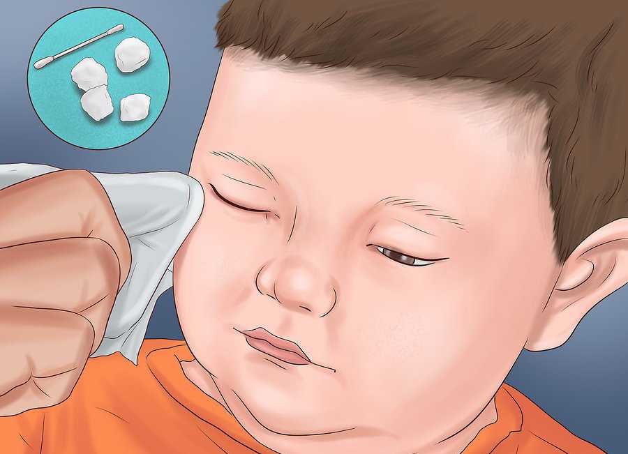 Гной из глаз кашель насморк у ребенка