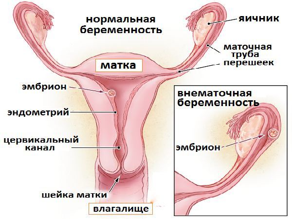 Беременность при спайках в кишечнике