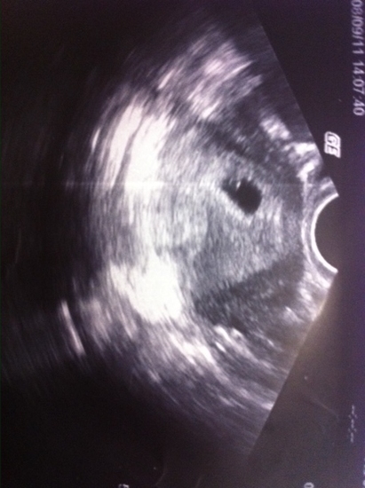 Узи на 6 неделе беременности: размеры плода, что показывает и как делают, если не видно эмбрион, видно только плодовое яйцо, двойня, фото