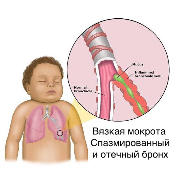 Комаровский – бронхит: обструктивная форма, лечение у детей, отзывы