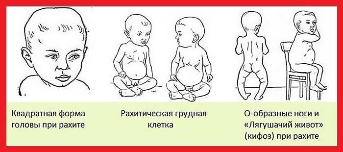 Профилактика рахита у детей: рекомендации для детей раннего возраста, особенности для недоношенных детей