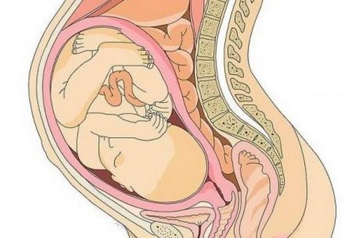 Предлежание плаценты: «безвыходная» беременность - наблюдение беременности.  здоровье