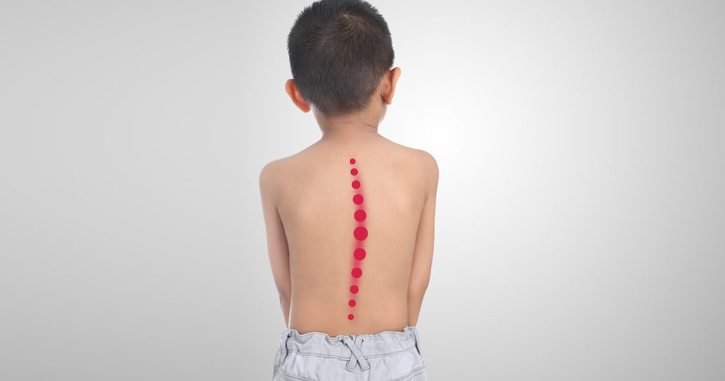 Нарушение осанки у детей и подростков: искривление позвоночника, профилактика нарушений и формирование прямой спины