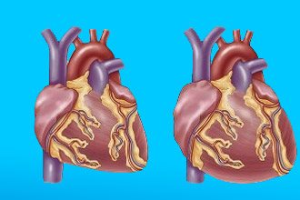 Функциональная кардиопатия у детей что это такое — cardio