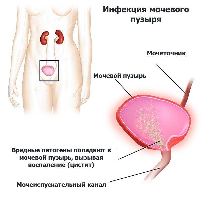 Симптомы цистита у девочек и лечение воспаления мочевого пузыря у детей разного возраста