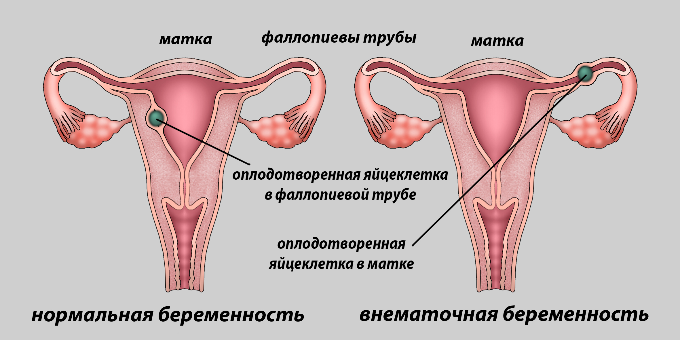 Патологии маточных труб и беременность - проблемы с зачатием