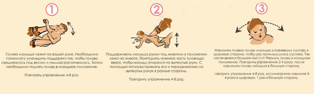 Кривошея у грудничка и новорожденного: признаки, симптомы, фото, лечение