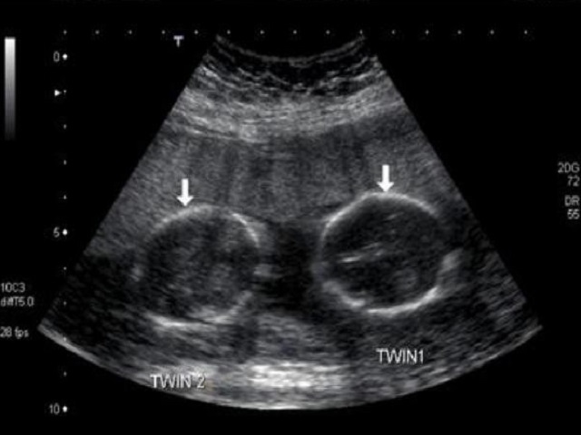 Двойня на ранних сроках беремености признаки двойни фото узи двойни 8,12,16 недель