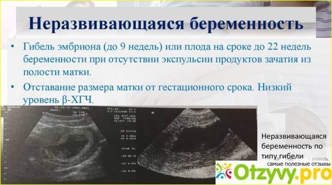 Замершая беременность: симптомы, причины и последствия - беременность
