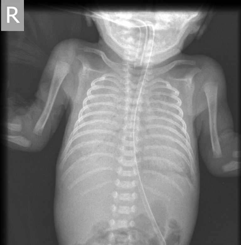 Когда нужно делать рентген ребенку при кашле