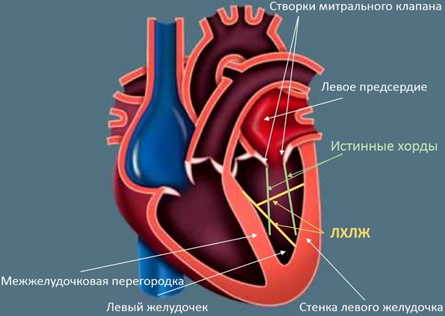 Дополнительная хорда в сердце у ребенка: дхлж, лишняя хорда, хорда левого желудочка сердца