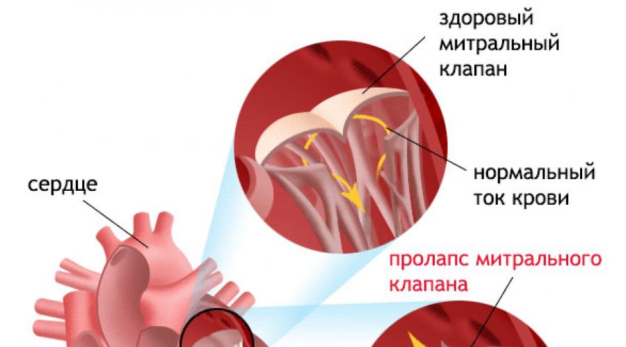Пролапс митрального клапана без нарушения гемодинамики | лечим сердце