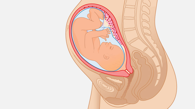 Низкое предлежание плода: низкое расположение плода при беременности, ребенок низко расположен в матке – чем грозит