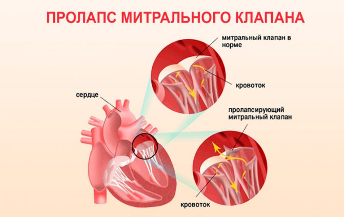Все о пролапсе клапанов сердца и их лечении