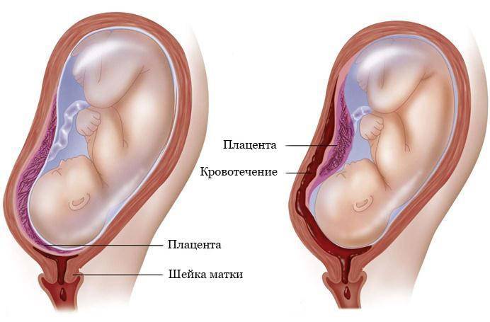 Плацента по передней стенке - что означает расположение по передней стенке матки
