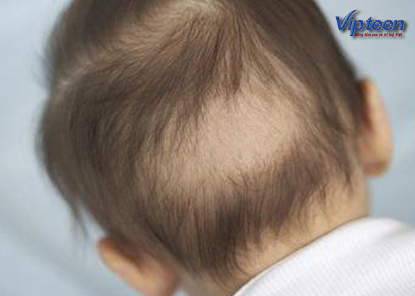 Выпадают волосы у грудничка (14 фото): причины залысин на затылке и облысения у новорожденного ребенка