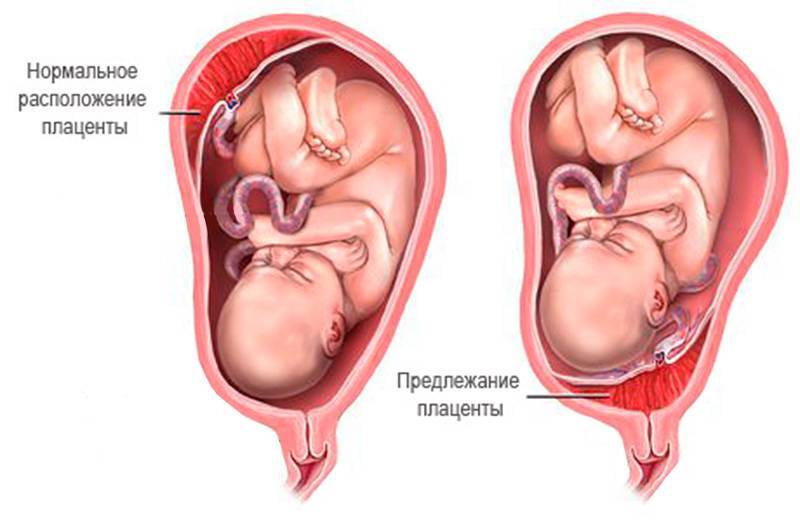 Предлежание плаценты (36 фото): положение хориона при беременности, что такое неполное расположение и миграция