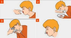 Носовые кровотечения у детей: причины и первая помощь