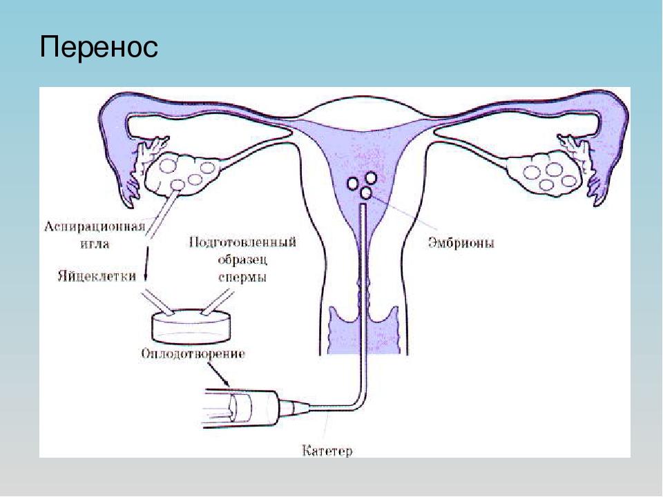Перенос эмбрионов при эко или как происходит подсадка?
