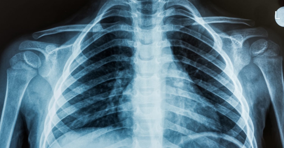 Рентген легких: что показывает, как часто можно делать, где сделать, как делают?