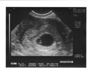 Не определяется эмбрион на 6 неделе беременности