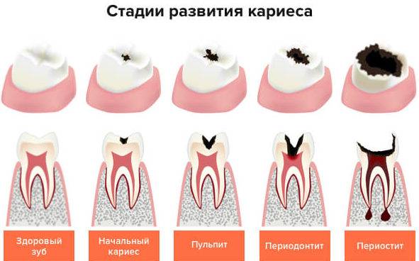 Зубная боль при грудном вскармливании, чем лечить, обезболить зубную боль у мамы