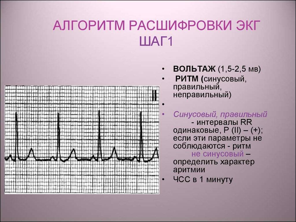 Обозначения экг расшифровка фото