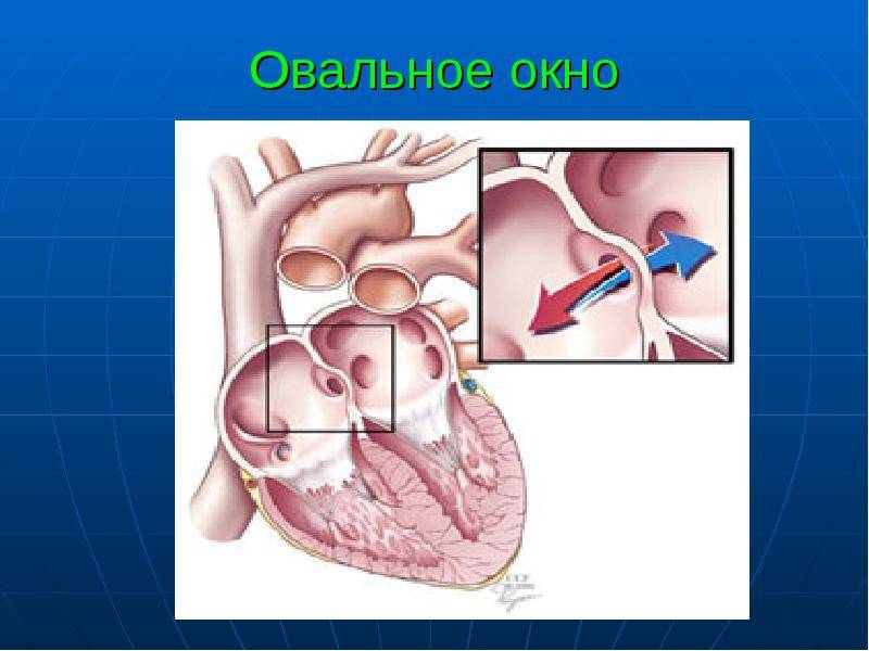 Открытое овальное окно в сердце у ребенка: у грудничка и новорожденного дырка в серце