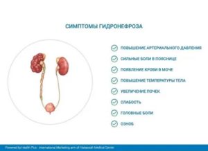 Гидронефроз у детей презентация