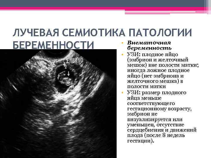 Анэмбриония: плодное яйцо без эмбриона, причины, симптомы, лечение